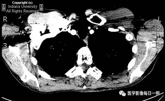 【病例】肺脓肿1例X线及CT 【病例】肺脓肿1例X线及CT