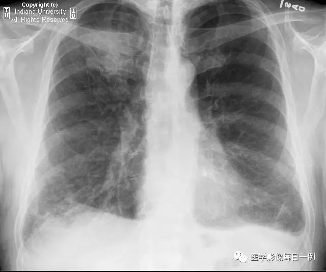 【病例】肺脓肿1例X线及CT 【病例】肺脓肿1例X线及CT