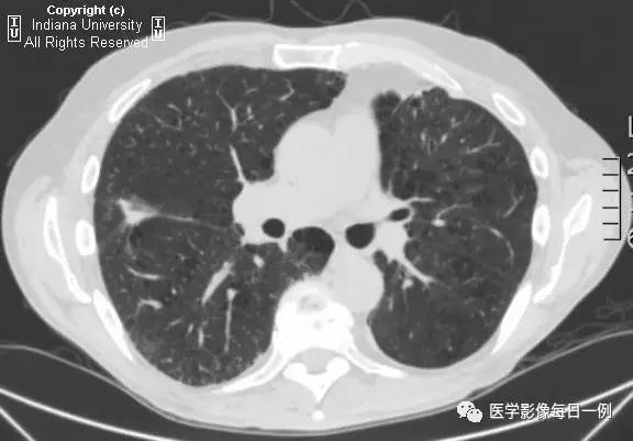 【病例】肺脓肿1例X线及CT 【病例】肺脓肿1例X线及CT
