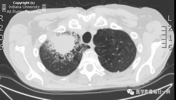 【病例】肺脓肿1例X线及CT 【病例】肺脓肿1例X线及CT