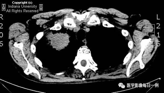【病例】肺脓肿1例X线及CT 【病例】肺脓肿1例X线及CT