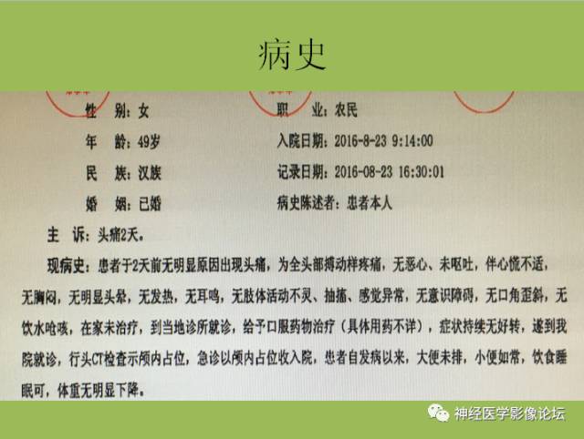 【病例】小脑纤维型脑膜瘤一例MR影像表现