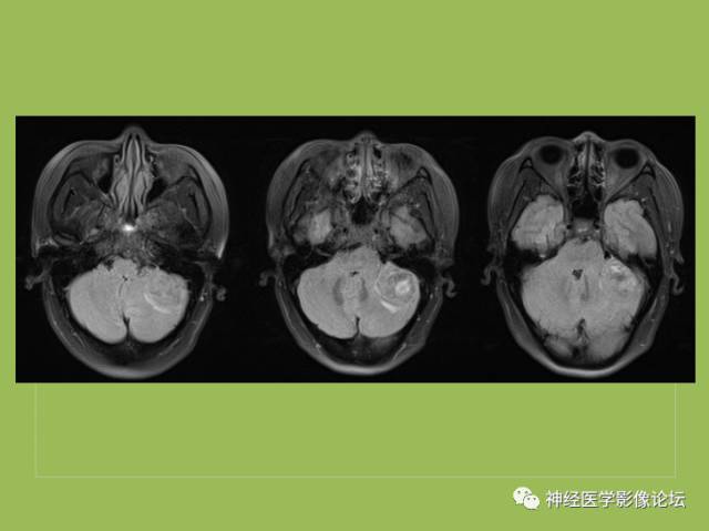【病例】小脑纤维型脑膜瘤一例MR影像表现