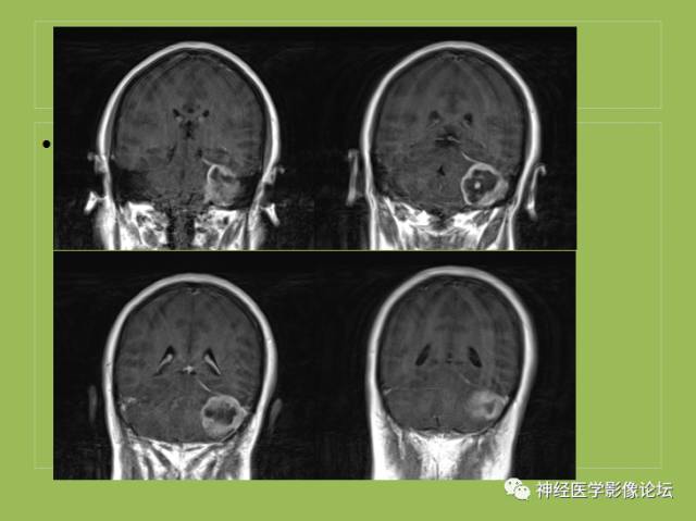 【病例】小脑纤维型脑膜瘤一例MR影像表现