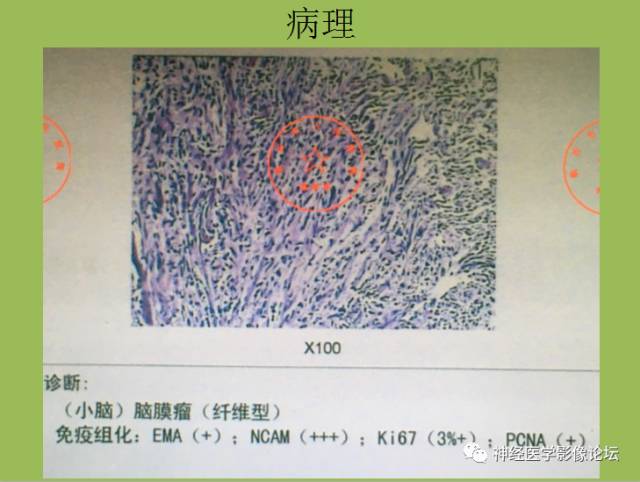 【病例】小脑纤维型脑膜瘤一例MR影像表现