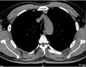 【病例】纵隔血管平滑肌脂肪瘤1例CT 【病例】纵隔血管平滑肌脂肪瘤1例CT