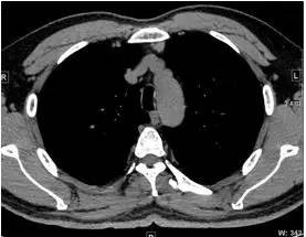 【病例】纵隔血管平滑肌脂肪瘤1例CT 【病例】纵隔血管平滑肌脂肪瘤1例CT