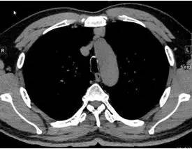 【病例】纵隔血管平滑肌脂肪瘤1例CT 【病例】纵隔血管平滑肌脂肪瘤1例CT