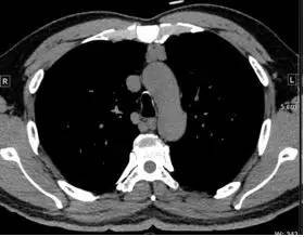 【病例】纵隔血管平滑肌脂肪瘤1例CT 【病例】纵隔血管平滑肌脂肪瘤1例CT