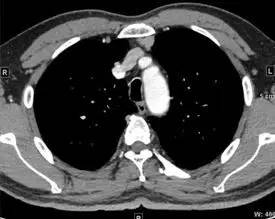 【病例】纵隔血管平滑肌脂肪瘤1例CT 【病例】纵隔血管平滑肌脂肪瘤1例CT