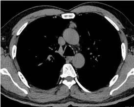 【病例】纵隔血管平滑肌脂肪瘤1例CT 【病例】纵隔血管平滑肌脂肪瘤1例CT