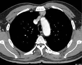 【病例】纵隔血管平滑肌脂肪瘤1例CT 【病例】纵隔血管平滑肌脂肪瘤1例CT