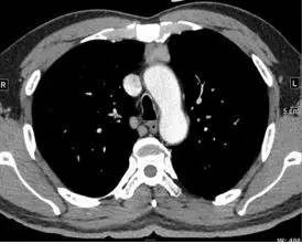 【病例】纵隔血管平滑肌脂肪瘤1例CT 【病例】纵隔血管平滑肌脂肪瘤1例CT