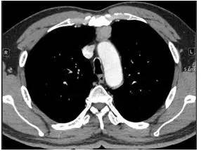 【病例】纵隔血管平滑肌脂肪瘤1例CT 【病例】纵隔血管平滑肌脂肪瘤1例CT