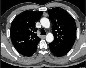【病例】纵隔血管平滑肌脂肪瘤1例CT 【病例】纵隔血管平滑肌脂肪瘤1例CT