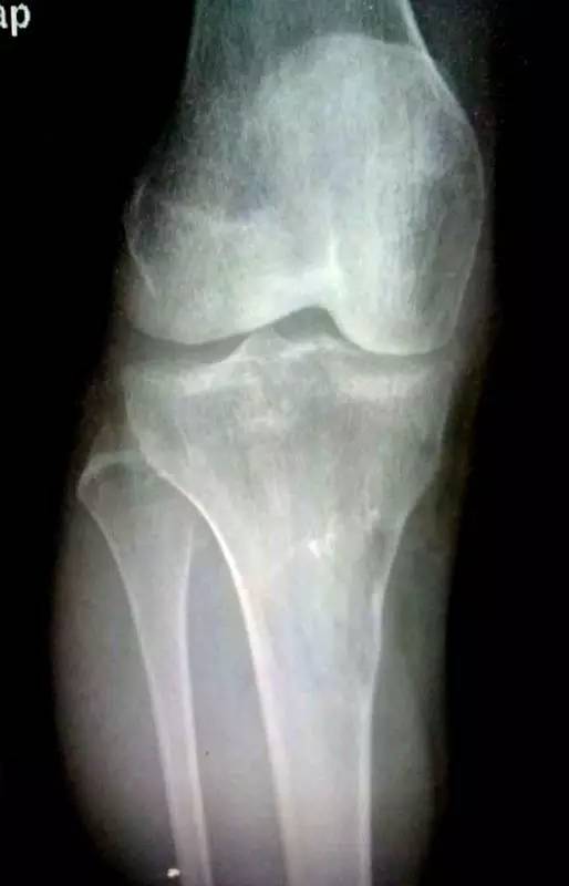 【病例】胫骨上皮样血管内皮瘤1例X线CT 【病例】胫骨上皮样血管内皮瘤1例X线CT