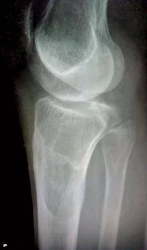 【病例】胫骨上皮样血管内皮瘤1例X线CT 【病例】胫骨上皮样血管内皮瘤1例X线CT