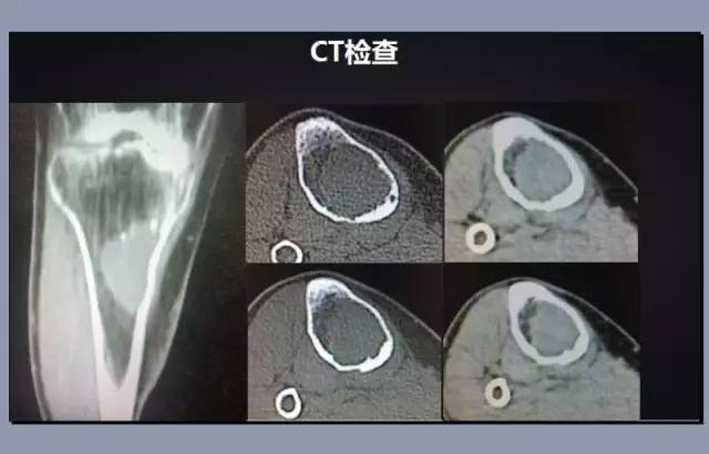 【病例】胫骨上皮样血管内皮瘤1例X线CT 【病例】胫骨上皮样血管内皮瘤1例X线CT