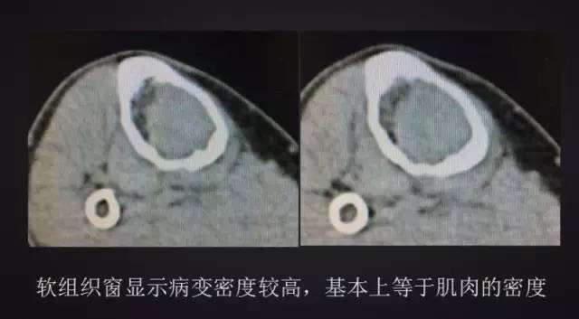 【病例】胫骨上皮样血管内皮瘤1例X线CT 【病例】胫骨上皮样血管内皮瘤1例X线CT