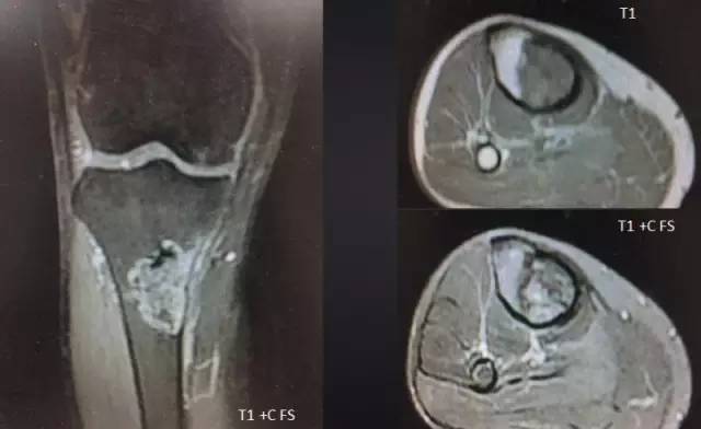 【病例】胫骨上皮样血管内皮瘤1例X线CT 【病例】胫骨上皮样血管内皮瘤1例X线CT