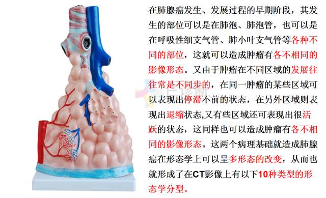 【PPT】微小肺癌的CT形态学分型