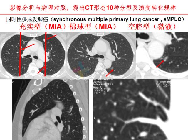 【PPT】微小肺癌的CT形态学分型