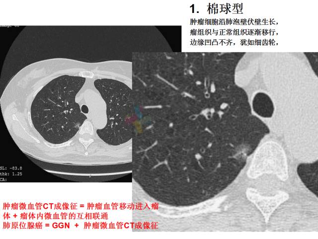 【PPT】微小肺癌的CT形态学分型