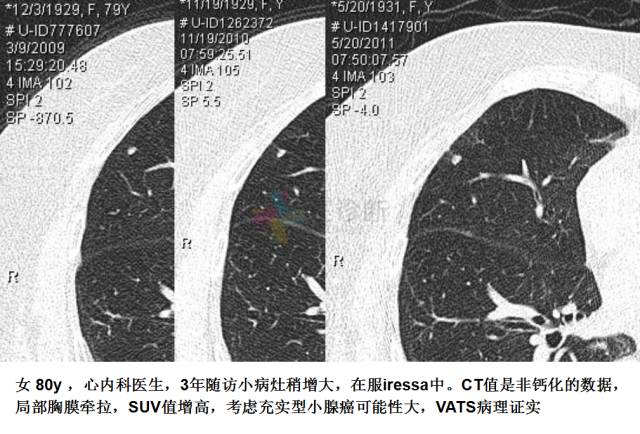【PPT】微小肺癌的CT形态学分型
