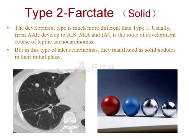 【PPT】微小肺癌的CT形态学分型