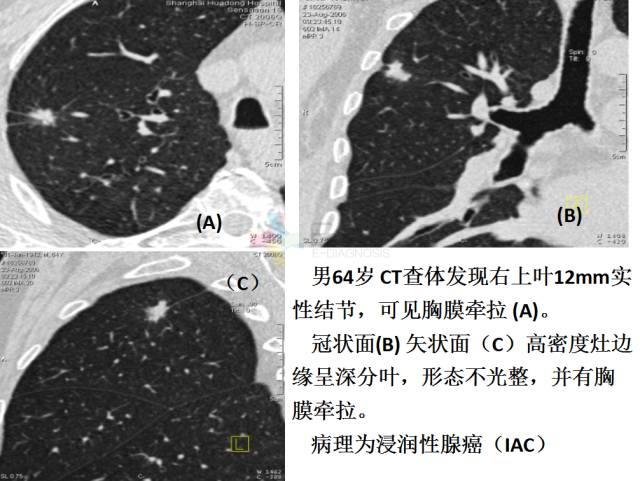 【PPT】微小肺癌的CT形态学分型