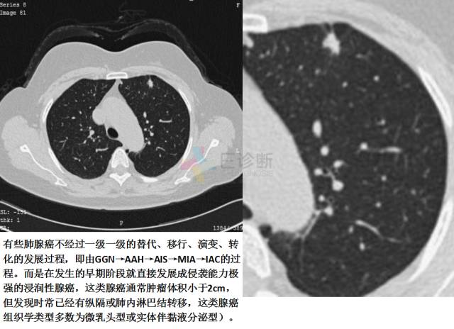 【PPT】微小肺癌的CT形态学分型