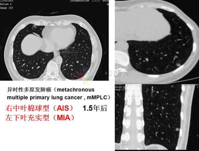 【PPT】微小肺癌的CT形态学分型