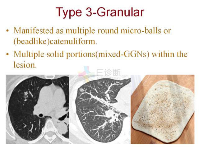 【PPT】微小肺癌的CT形态学分型