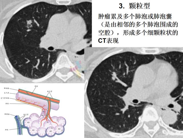 【PPT】微小肺癌的CT形态学分型