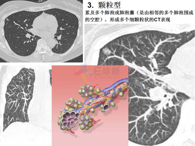 【PPT】微小肺癌的CT形态学分型