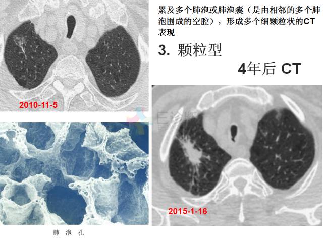 【PPT】微小肺癌的CT形态学分型