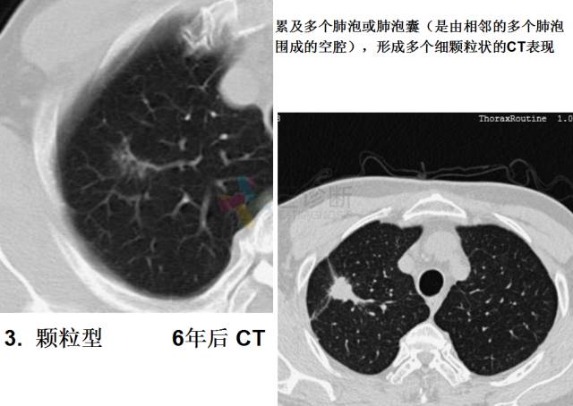 【PPT】微小肺癌的CT形态学分型