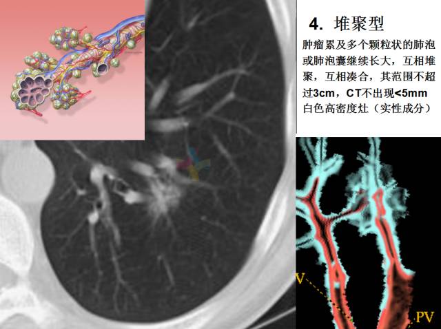 【PPT】微小肺癌的CT形态学分型