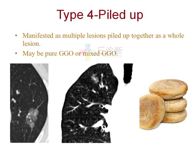 【PPT】微小肺癌的CT形态学分型