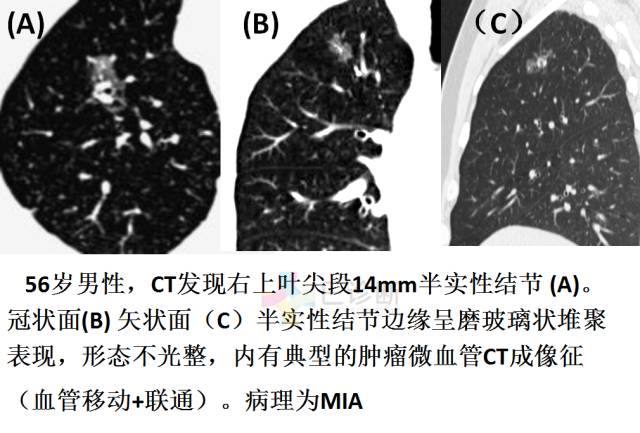 【PPT】微小肺癌的CT形态学分型