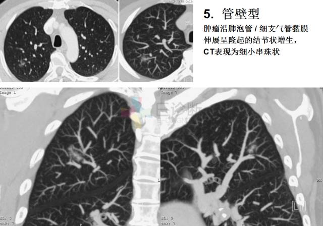 【PPT】微小肺癌的CT形态学分型