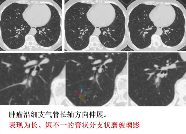 【PPT】微小肺癌的CT形态学分型