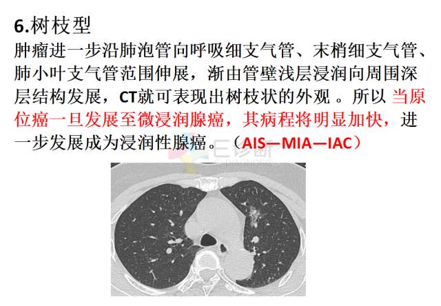 【PPT】微小肺癌的CT形态学分型