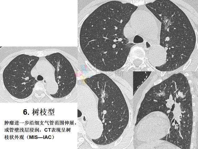 【PPT】微小肺癌的CT形态学分型