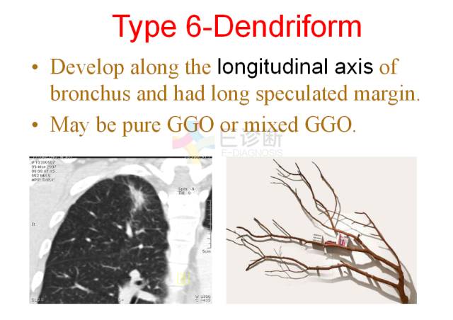 【PPT】微小肺癌的CT形态学分型