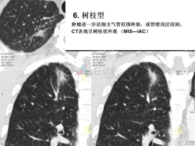 【PPT】微小肺癌的CT形态学分型