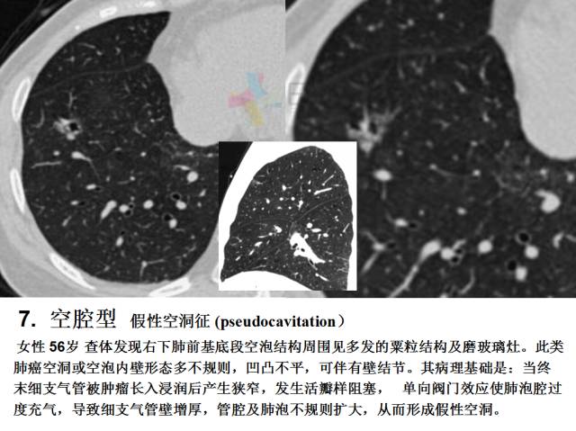 【PPT】微小肺癌的CT形态学分型
