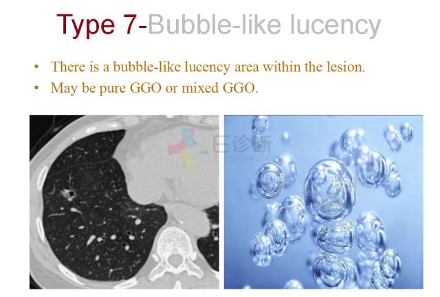 【PPT】微小肺癌的CT形态学分型