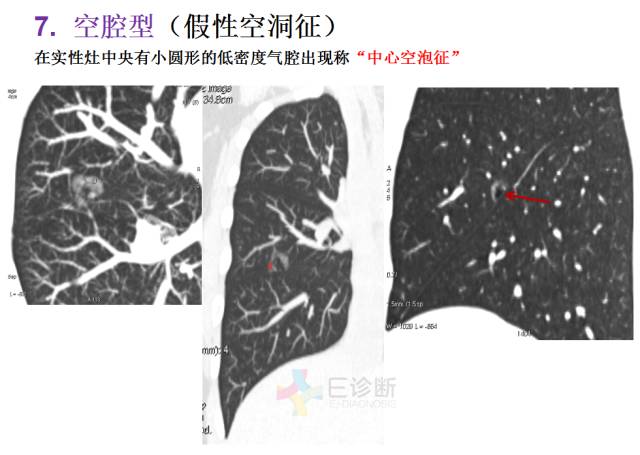 【PPT】微小肺癌的CT形态学分型