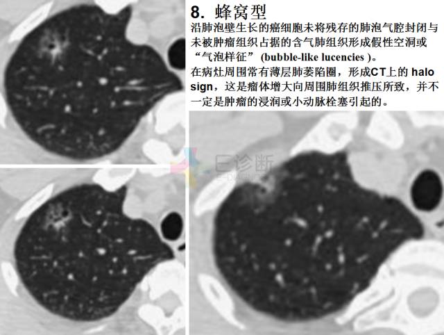 【PPT】微小肺癌的CT形态学分型